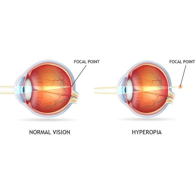 The difference between long sightedness and short sightedness – The Eye ...
